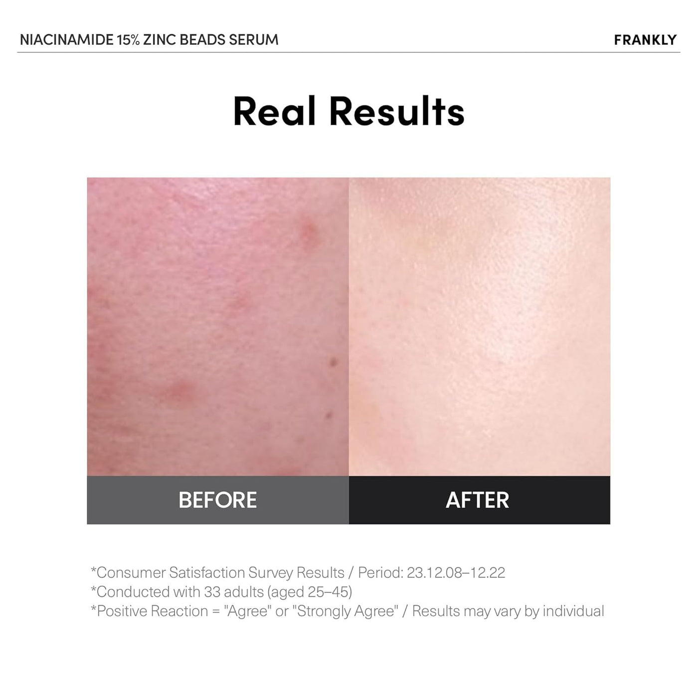 FRANKLY Niacinamide 15% Zinc Beads Serum 30ml