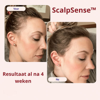ScalpSense™ - Stimuleer de doorbloeding. Activeer de haargroei.